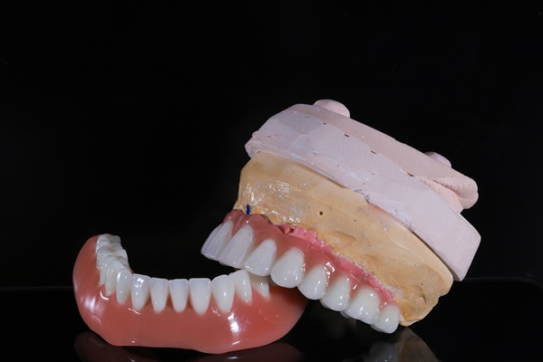 How Many Implants Are Needed For Lower Implant Supported Dentures?